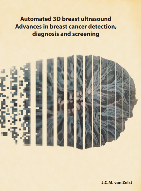 Automated 3D breast ultrasound Advances in breast cancer detection, diagnosis and screening
